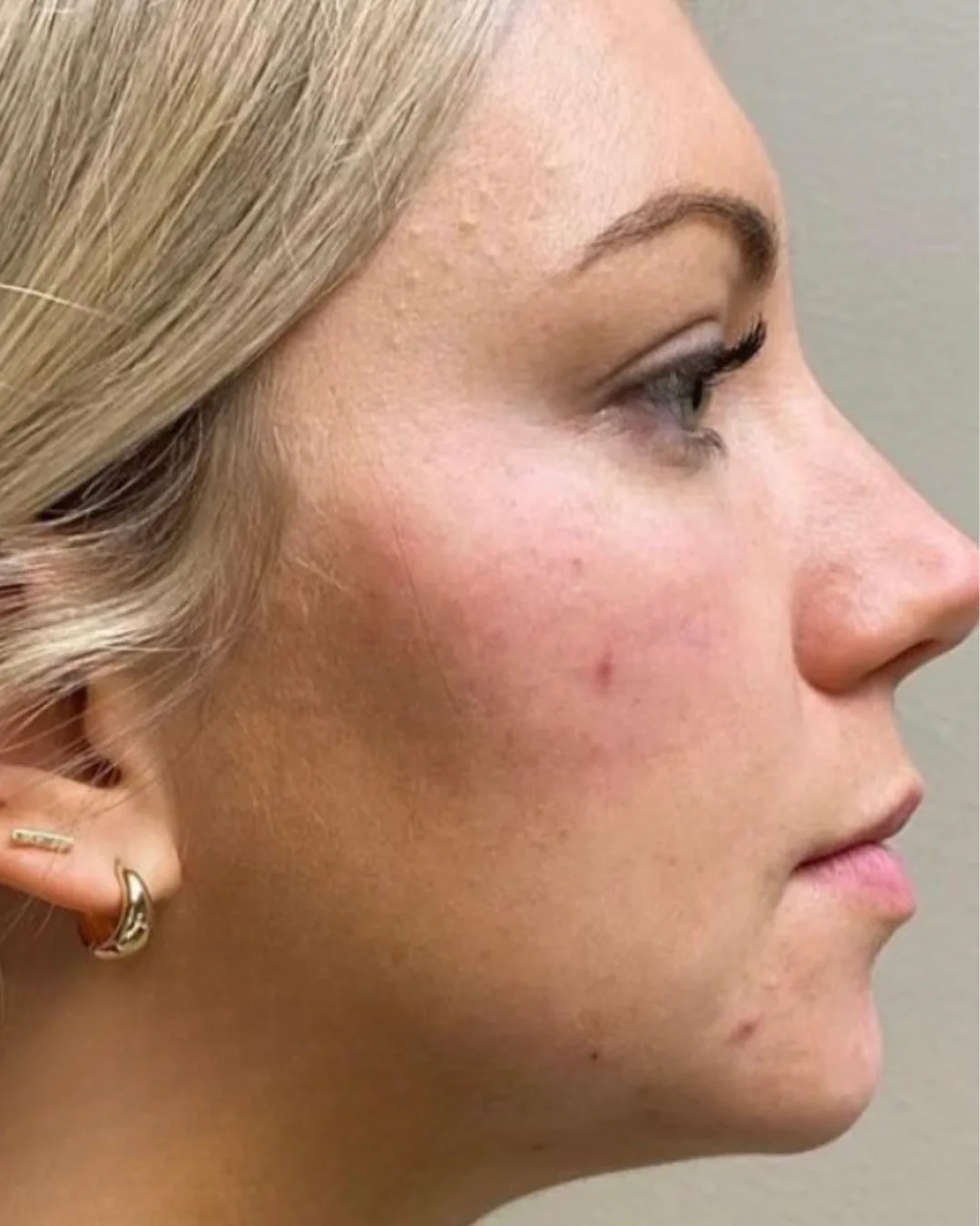 A real Sona MedSpa facial rejuvenation result, after treatment